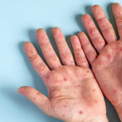 віспа Болград